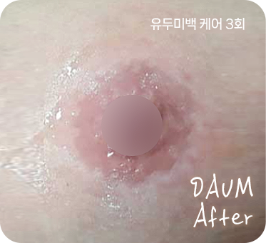 유두미백 시술 후 After nipple whitening treatment