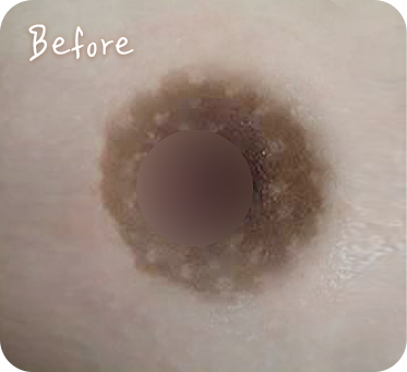 유두미백 Nipple whitening