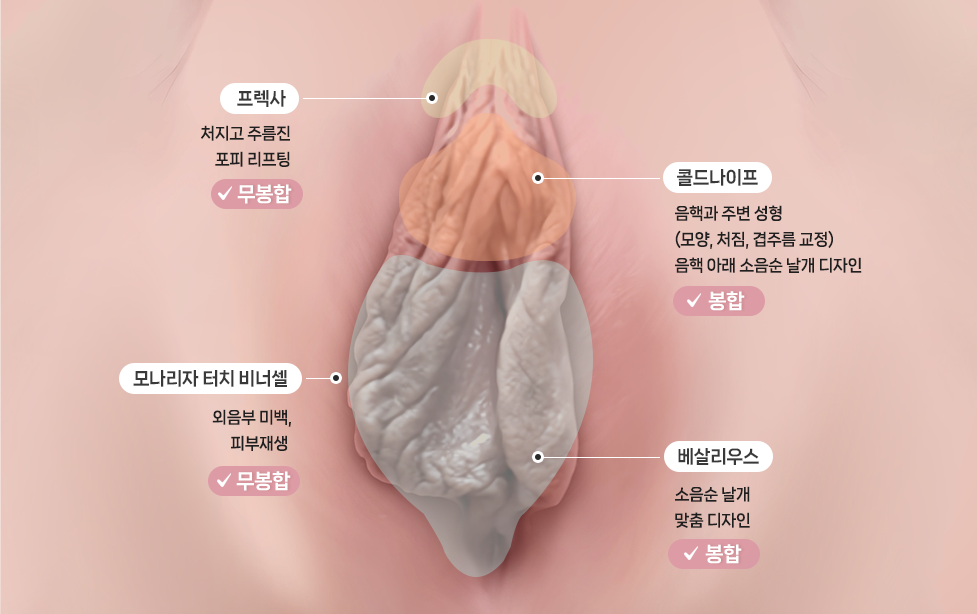 다움산부인과의 4단계 소음순성형 테크닉 Four-step technique for labiaplasty at Daum Women’s Clinic