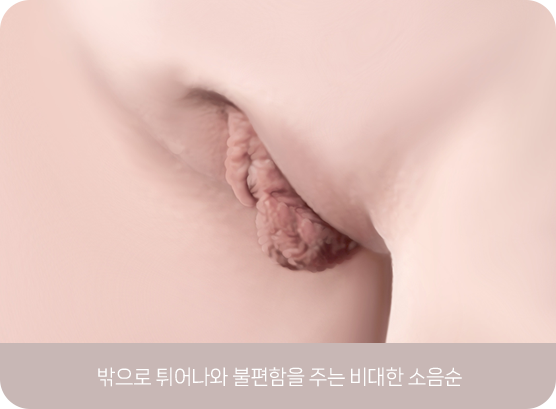 크기가 커서 생활의 불편함을 주는 소음순 모양 Enlarged labial shape causing daily discomfort