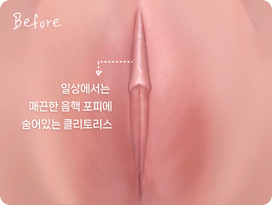 Clitoris normally concealed under smooth clitoral hood