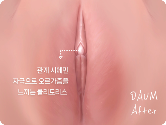 Clitoral anatomy related to stimulation during intercourse: clitoral hood surgery