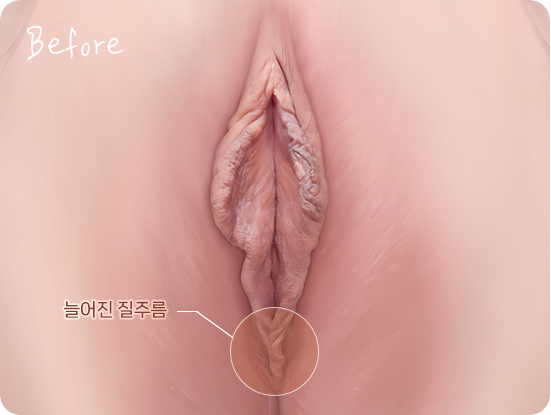 출산, 회음 절개, 성관계, 노화 등으로 변형된 소음순 : 늘어진 질 주름, 착색 고민 Labial changes from childbirth, episiotomy, intercourse, and aging: stretched vaginal folds and pigmentation concern 