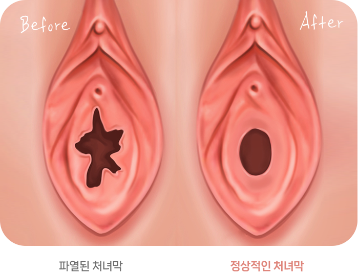 처녀막 성형술 전후 Hymenoplasty procedure process