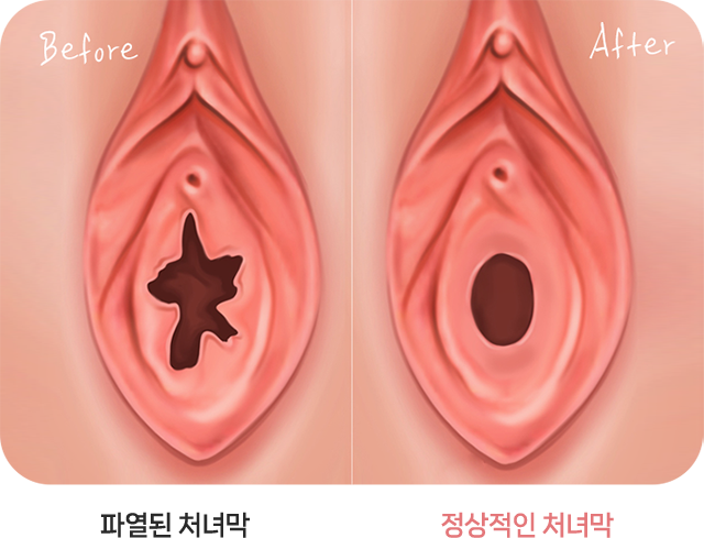 처녀막 성형술 전후 Hymenoplasty procedure process