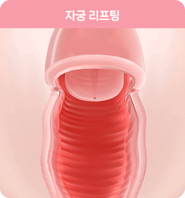 자궁경부 리프팅 : 질축소수술 Cervical lifting: vaginal tightening surgery