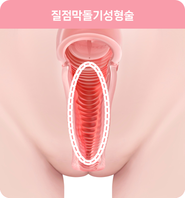 질 점막 돌기 성형술 : Vaginal mucosal ridge correction: vaginal tightening surgery