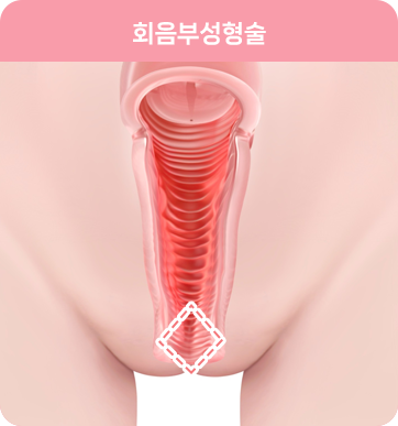 회음부 성형술 Perineoplasty